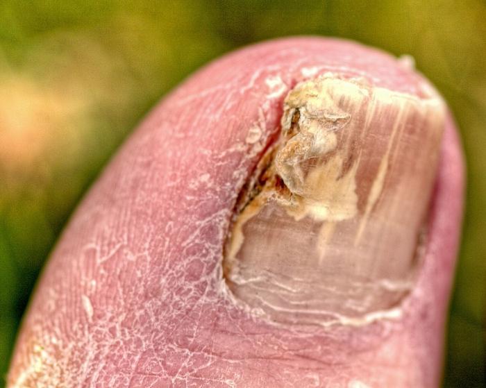 Traitement efficace du mycète des ongles sur les jambes avec des remèdes populaires