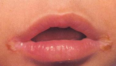 chéilite sur les lèvres de la cause
