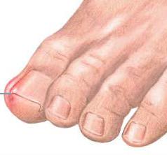 Sur la jambe d'un ongle développé: que faire dans ce cas?