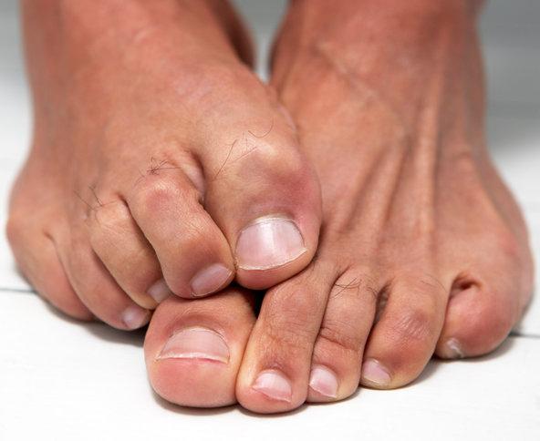 Un champignon malsain sur les ongles des pieds: traitement avec des remèdes populaires